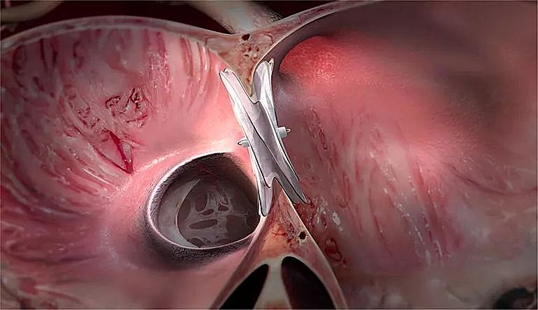 戈尔公司的CARDIOFORM心房间隔缺损封堵器获欧洲CE批准